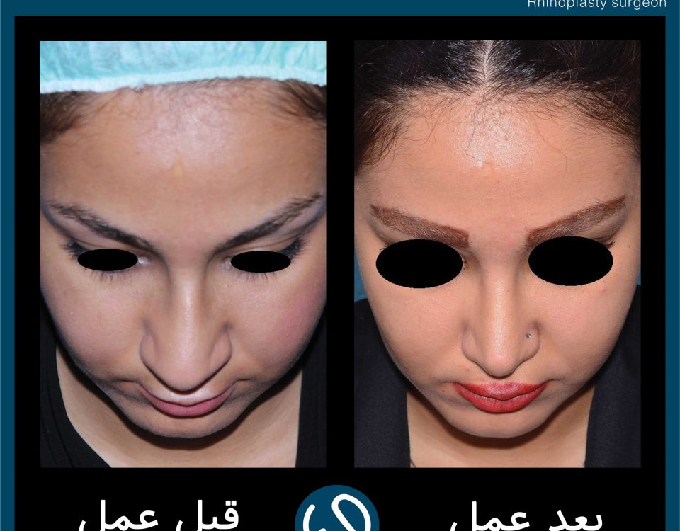 عکس قبل و بعد از عمل 64