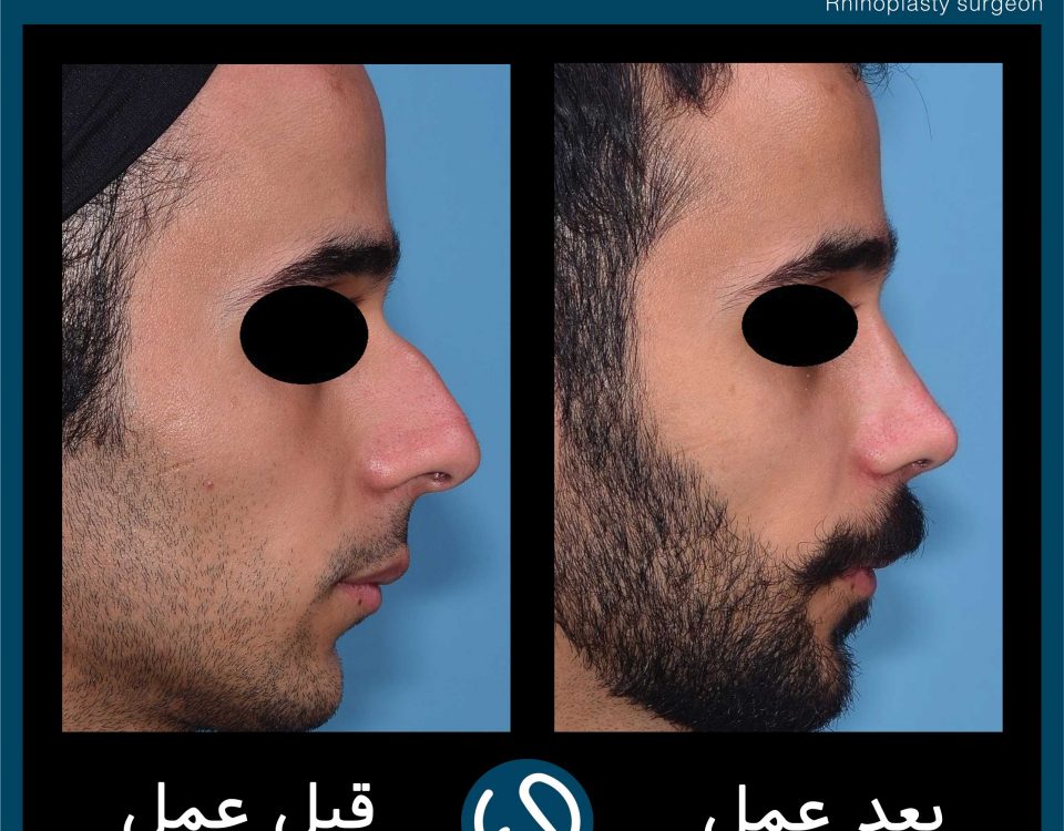 عکس قبل و بعد از عمل 78
