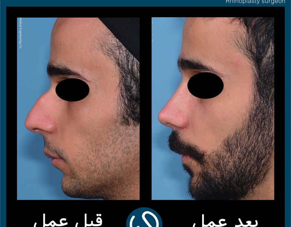 عکس قبل و بعد از عمل 79