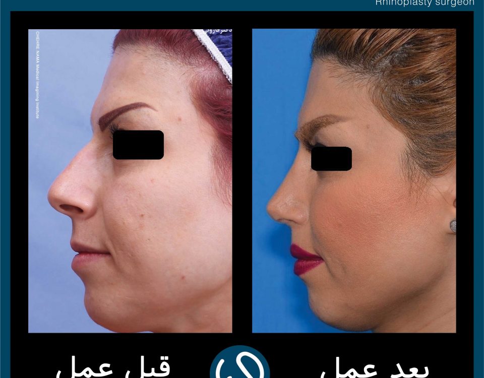 عکس قبل و بعد از عمل 87