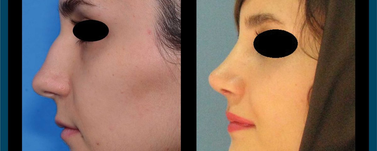عکس قبل و بعد از عمل 94