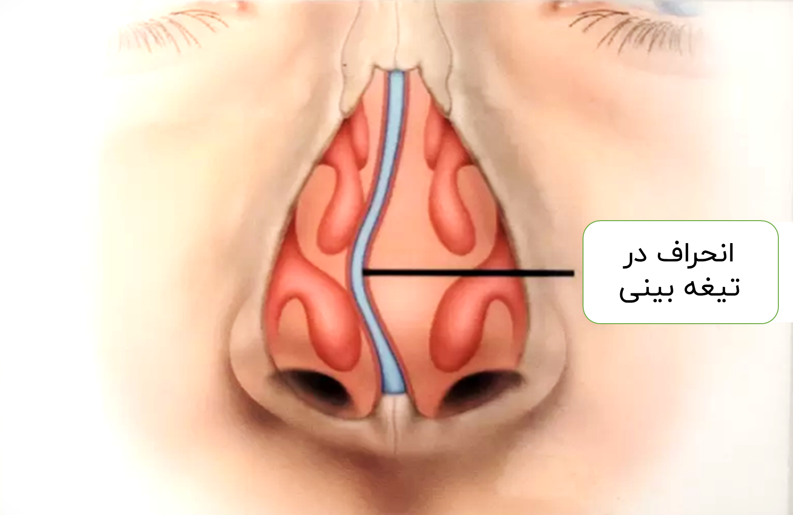 دلیل‌های ایجاد انحراف و اشکال در تیغه بینی چیستند؟
