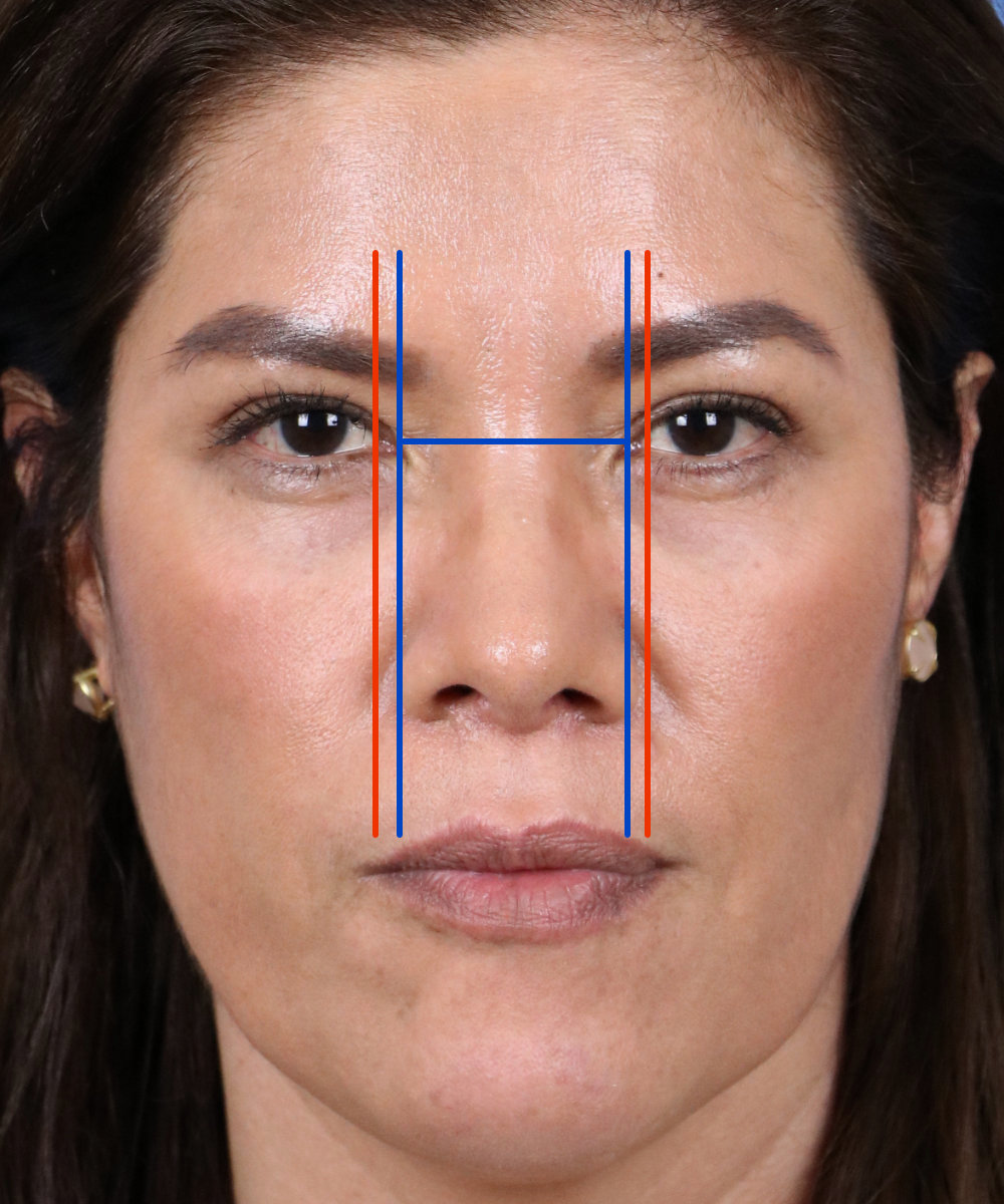 • اندازهگیری پهنای بینی