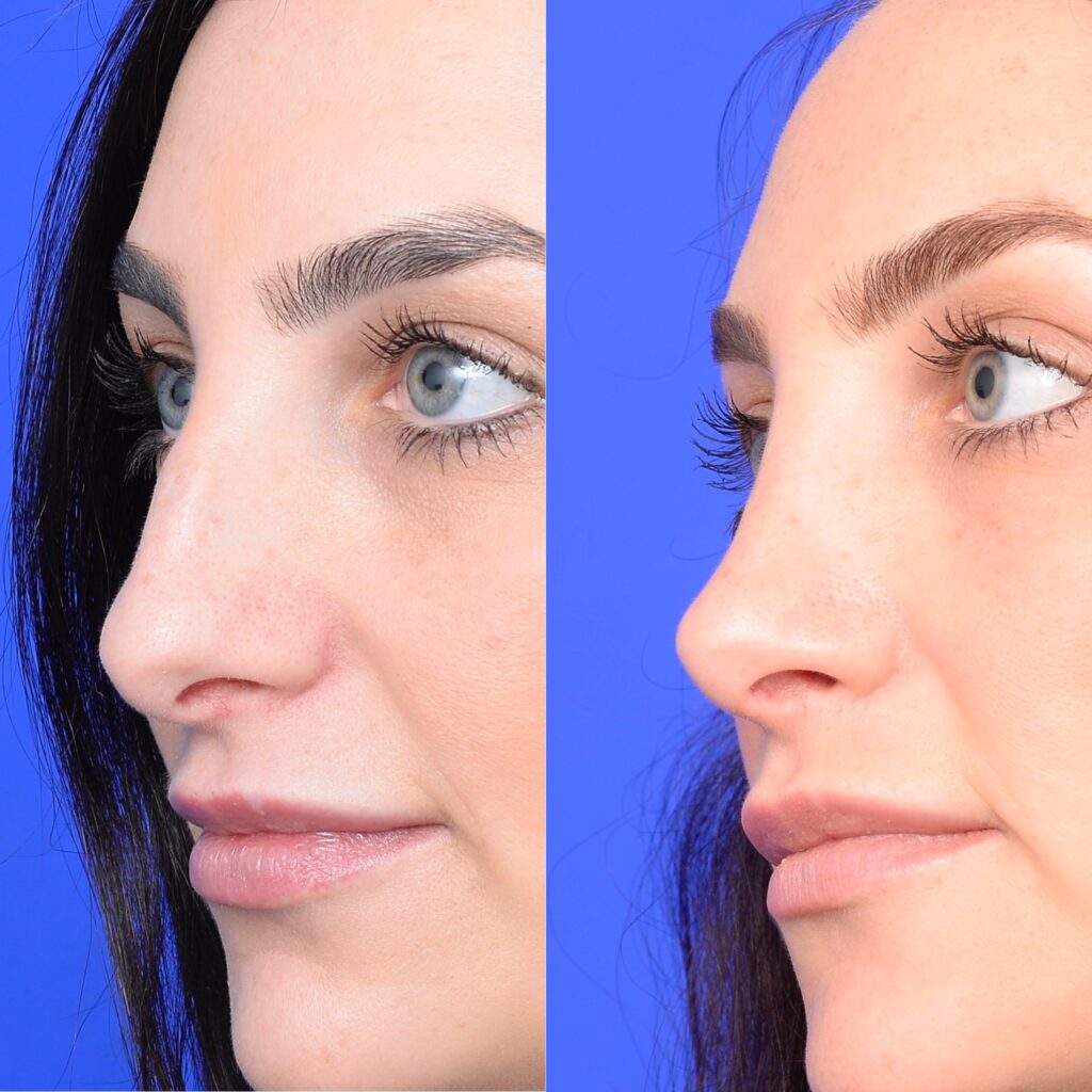 چالشهای عمل بینی پوستهای نازک چه چیزهایی هستند؟