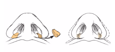چطور جراحی سوراخ های بینی به زیبا کردن آن کمک میکند؟
