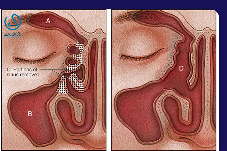 از کجا بفهمیم پولیپ بینی داریم؟