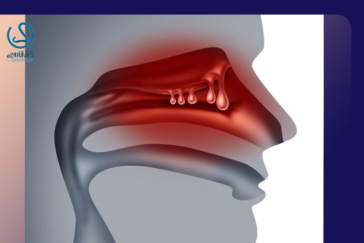 درمان دارویی پولیپ بینی