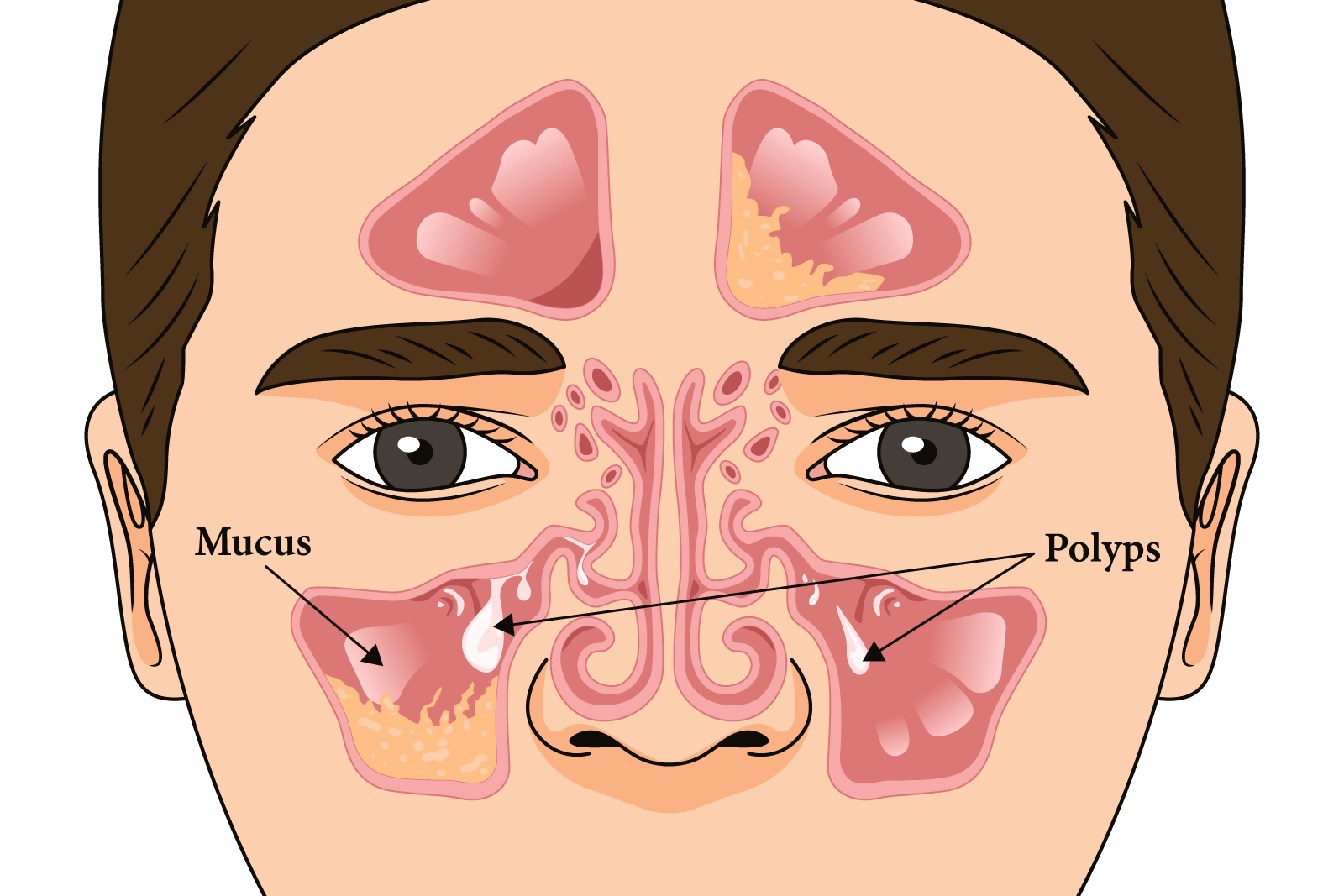 چه افرادی بیشتر در معرض ابتلا به پولیپ بینی قرار دارند؟