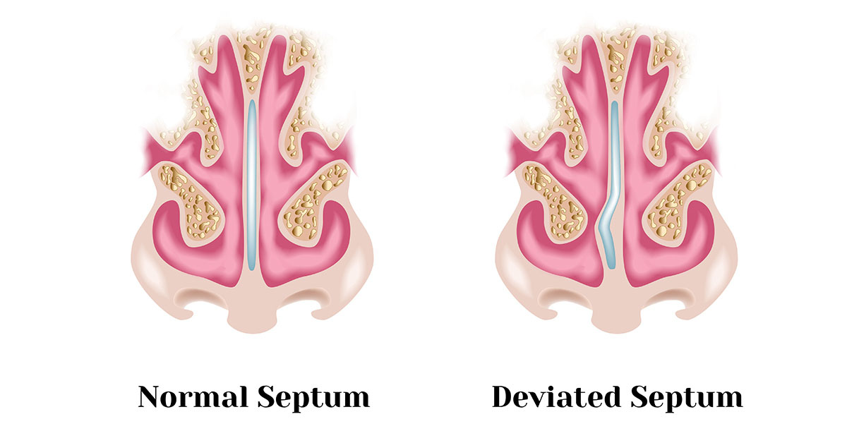 انواع انحراف بینی کدامند؟