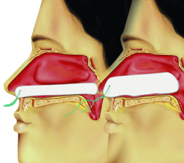 تامپون بینی چیست؟