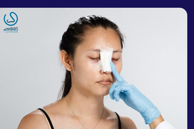 اسپلینت یا گچ بینی