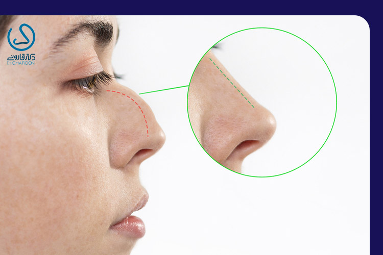 پل بینی چیست و چگونه درمان می شود؟
