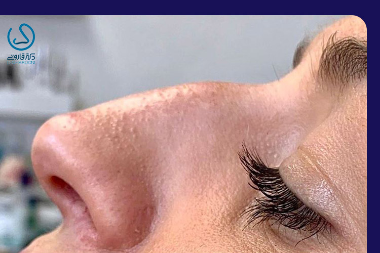 دلایل ایجاد اختلال در ریشه بینی چیست
