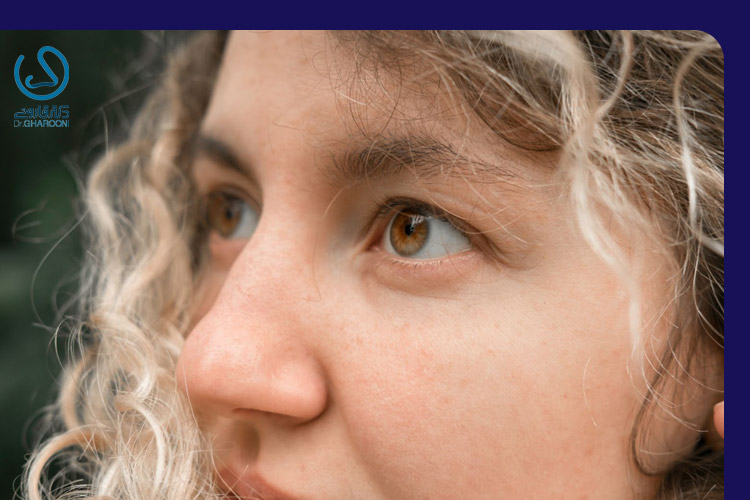 آیا پل یا ریشه بینی بعد از رینوپلاستی دچار ورم می‌شود؟