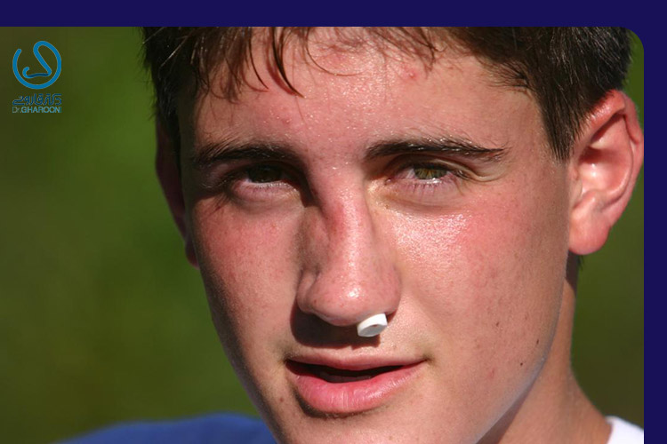 شکستگی پل بینی چیست؟