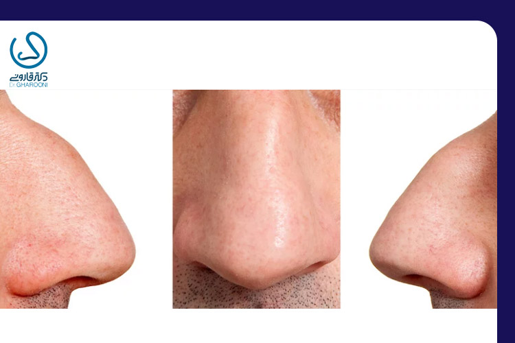 پل بینی افتاده