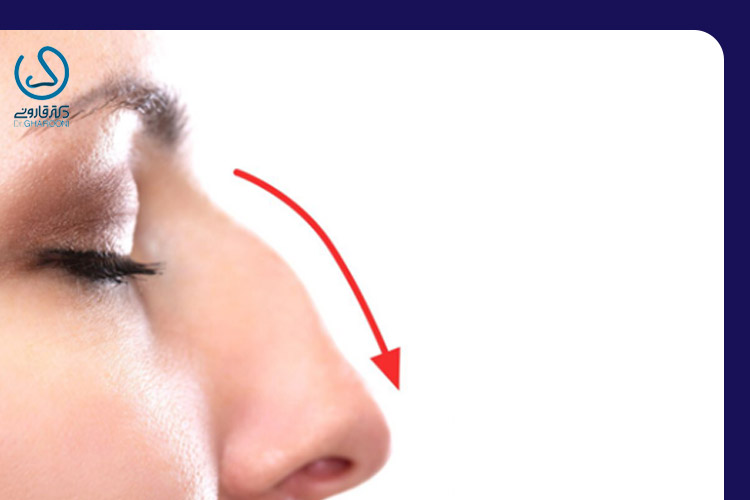 پل بینی برجسته