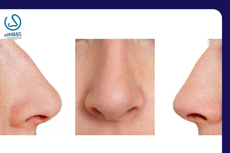 تصویر پل بینی خمیده