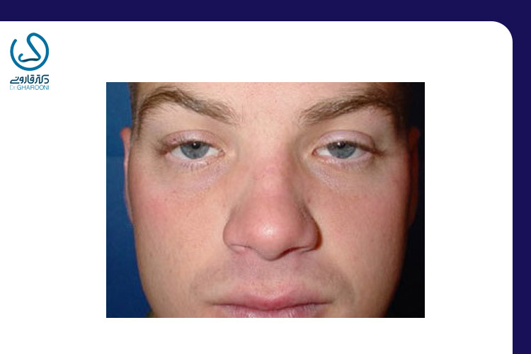 تصویر پل بینی خمیده