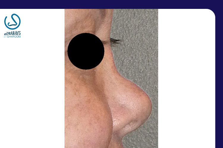 پل بینی فرورفته