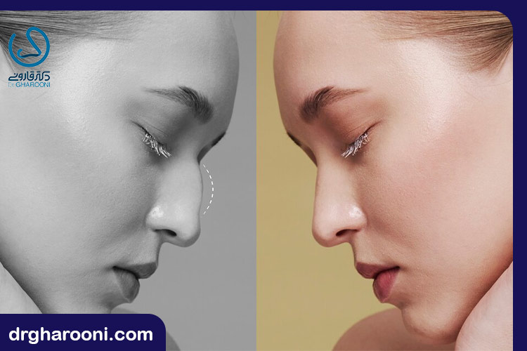 هیالورونیک اسید در فیلر بینی