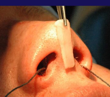 گرافت بینی چیست؟