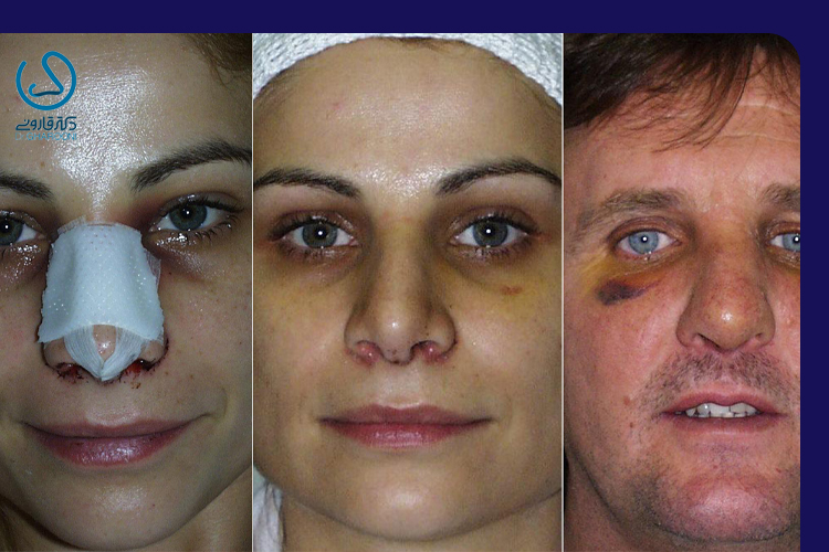 علت کبودی بعد از عمل بینی