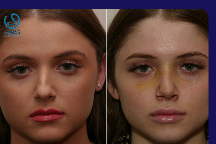 نکات و مراقبتهای لازم برای درمان کبودی بعد از عمل بینی