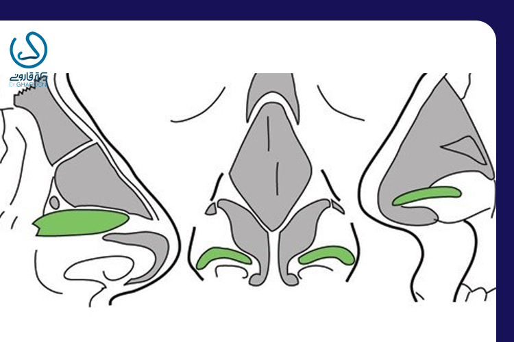 گرافت غضروف چگونه مورد استفاده قرار میگیرد