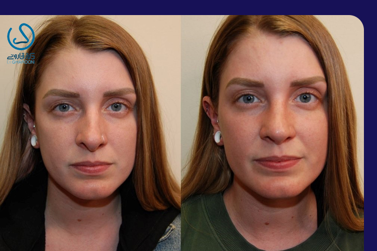 چه چیزی باعث دشوار بودن استفاده از گرافت در جراحی بینی میشود؟