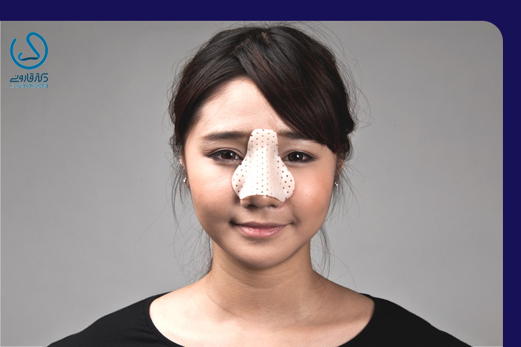 اسپلینت بینی