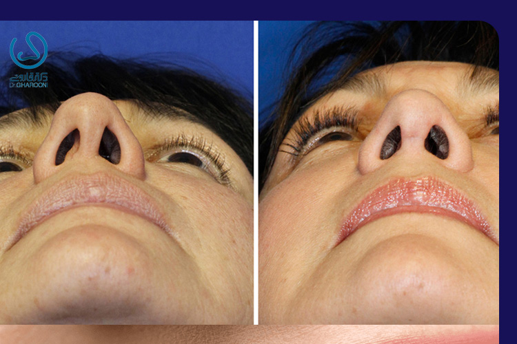 دلیل قرینه نبودن سوراخ بینی بعد از عمل چیست؟