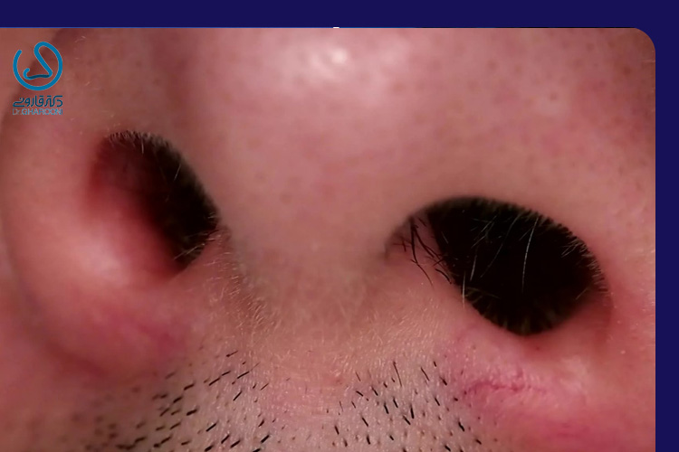 جلوگیری از نامتقارن شدن سوراخهای بینی بعد از عمل بینی