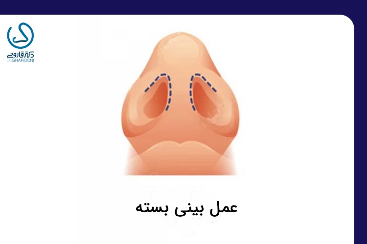 عمل بینی بسته 