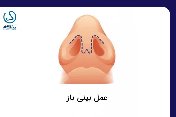 عمل بینی باز 