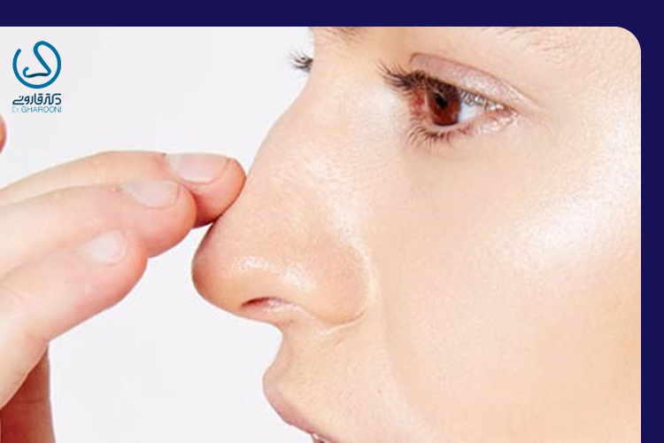 جلوگیری از قوز بینی