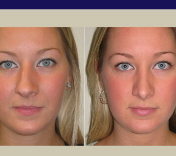 کج شدن بینی بعد از عمل