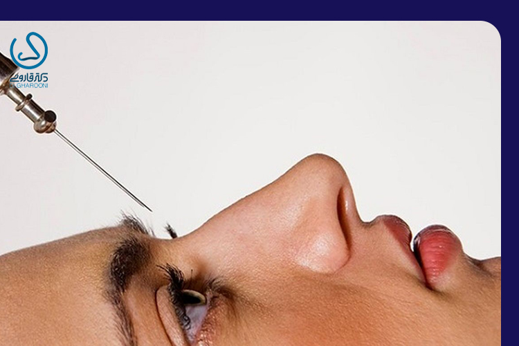 برآمدگی استخوان کنار بینی بعد از عمل