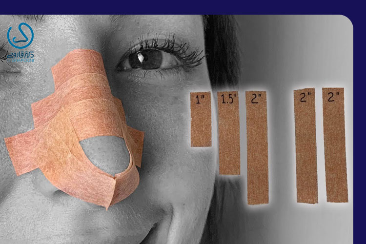 چسب زدن بینی بعد از عمل