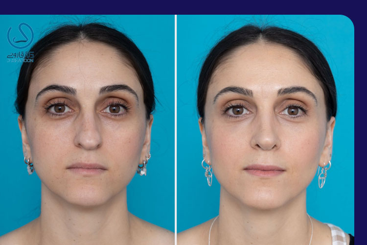 فرم‌ دهی بینی بدون جراحی چه مزایایی دارد؟