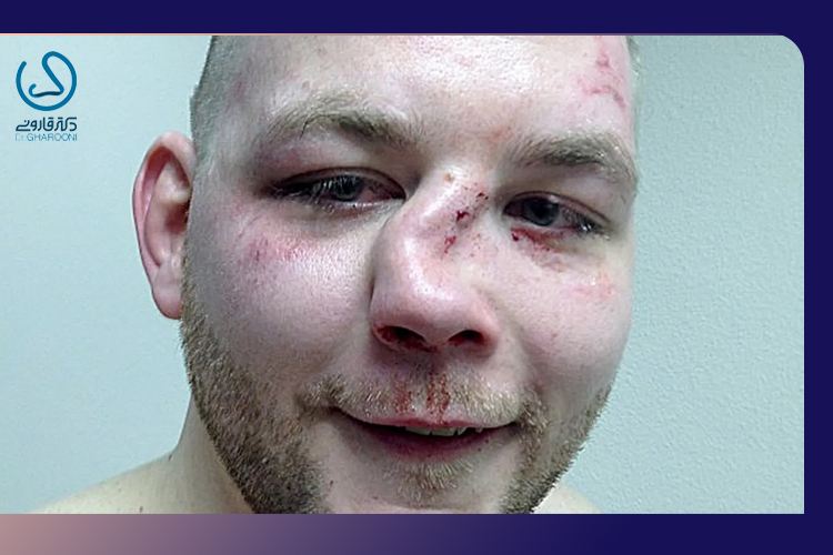 شکستگی بینی