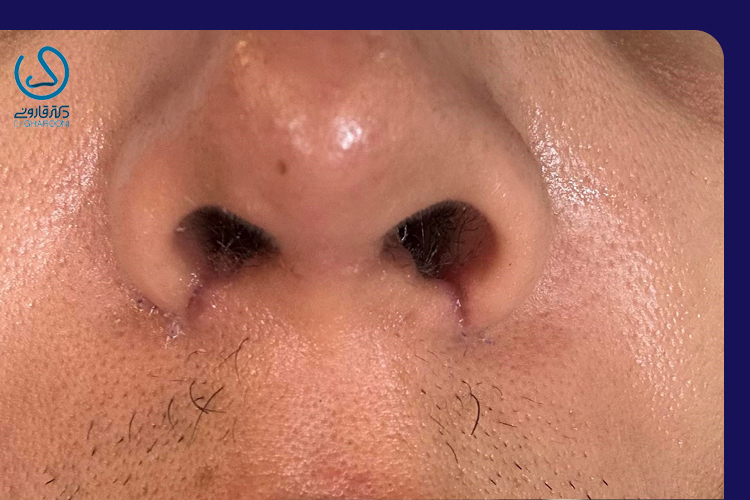 راهکارهای زیباجو برای جلوگیری از ایجاد گوشت اضافه بعد از عمل بینی با راهنمایی پزشک