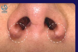 گوشت اضافه بعد از عمل بینی